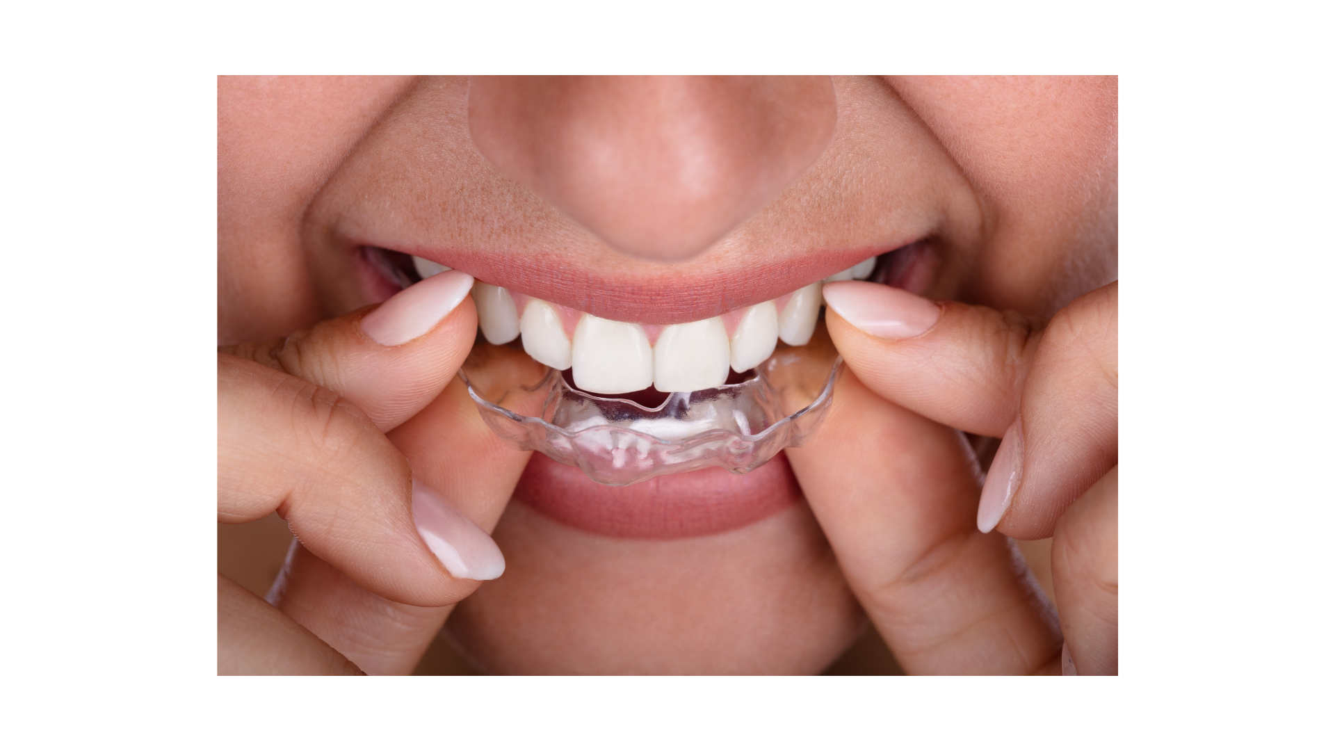 gouttières dents